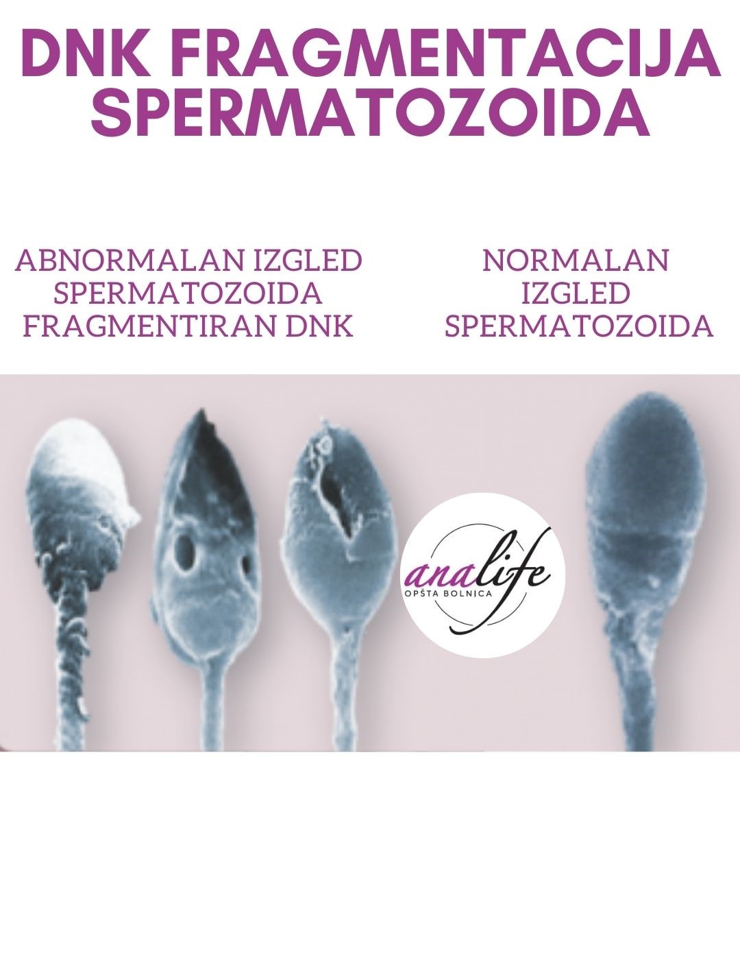 Šta je DNK fragmentacija spermatozoida?