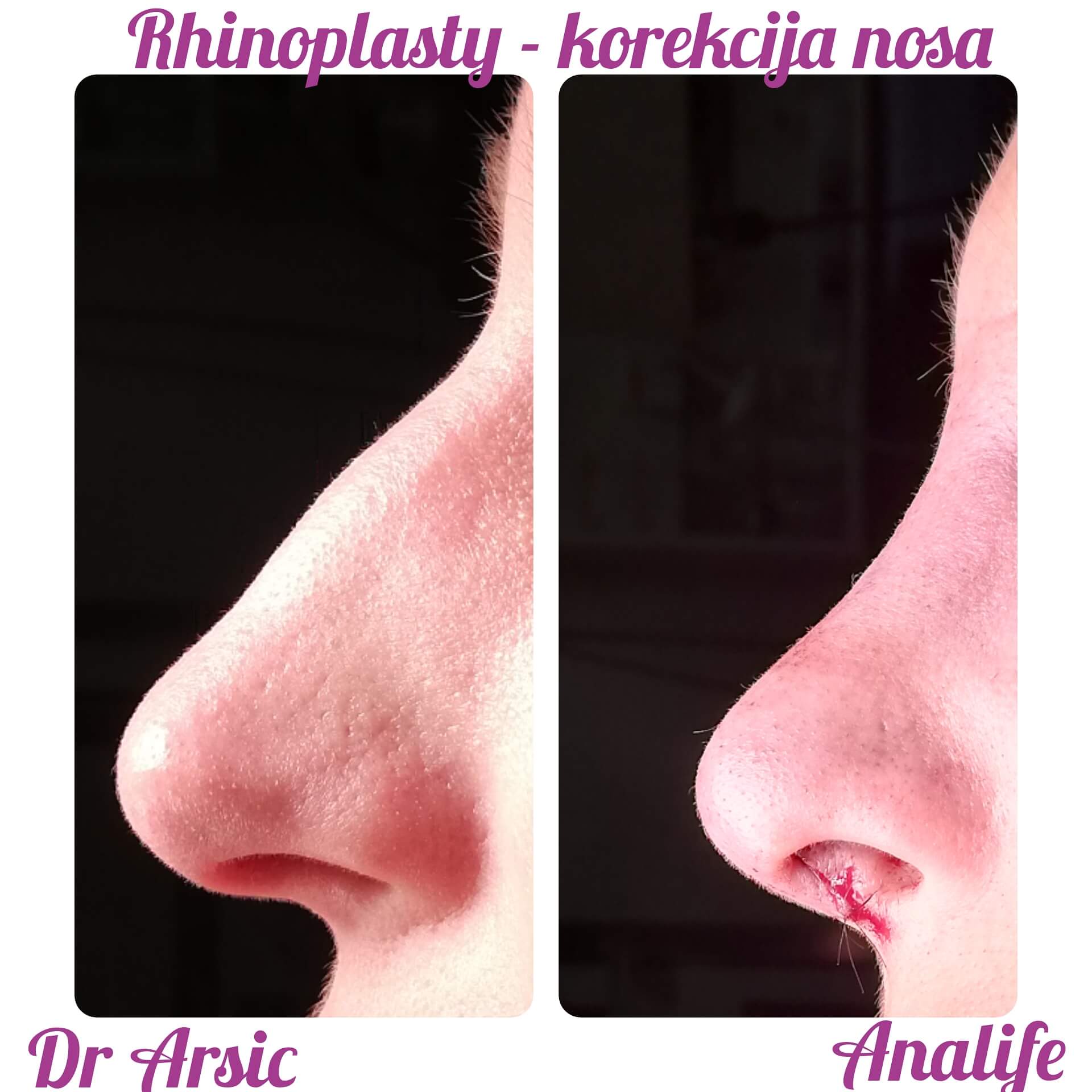 Estetska korekcija nosa je jedna od najzahtevnijih operacija jer se jasno uočava promena koja znatno doprinosi poboljšanju izgleda