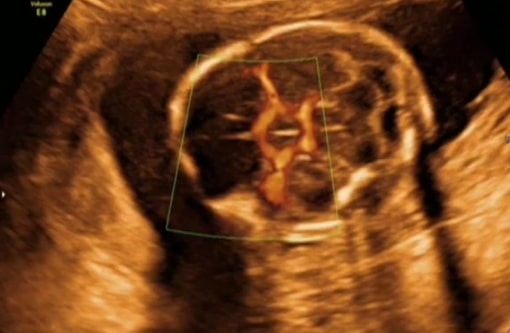 Šta sve može da se vidi na Ekspertskom 4D ultrazvučnom pregledu?