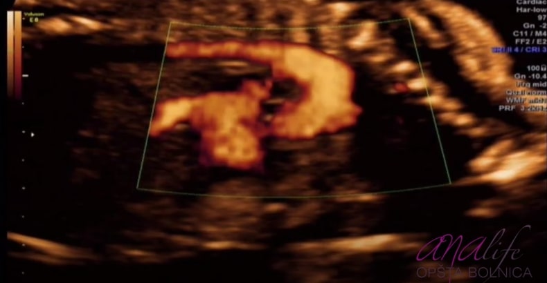 Šta je ekspertski 3D/4D ultrazvuk i kada ga treba uraditi? Dr Živanić