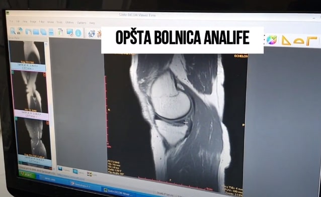 Artroskopija kolena - dr Miodrag Glišić, Analife