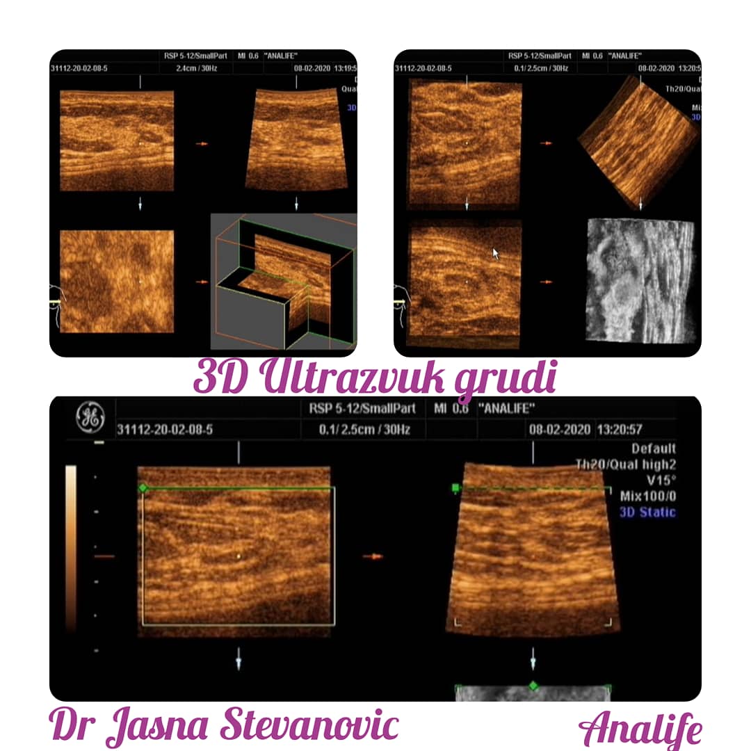 2D /3D ultrazvuk grudi i pazušnih jama radi naš radiolog dr Jasna Stevanović.