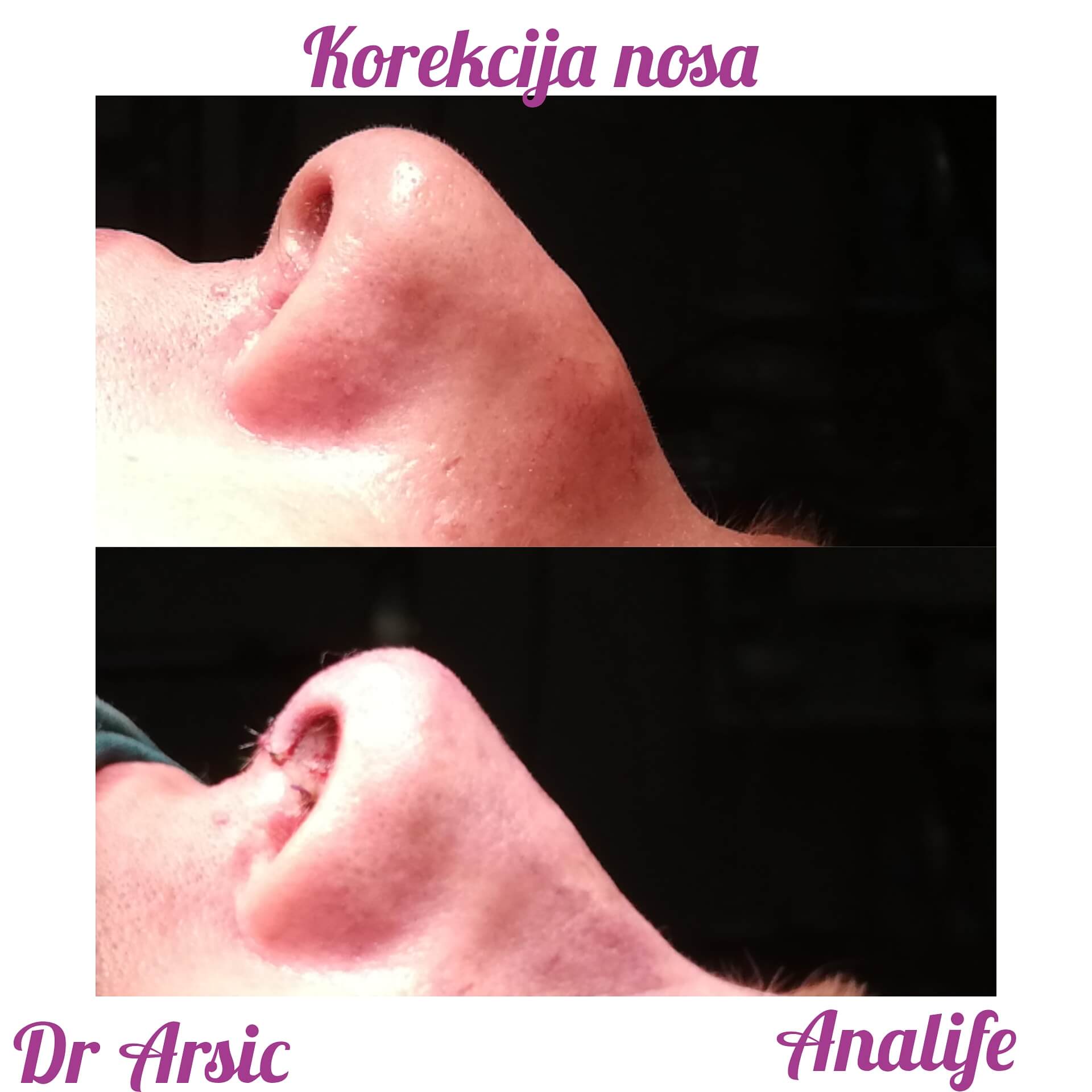 Najsavremenija operacija nosa - Graft tehnikama, po promotivnoj ceni od 1950e