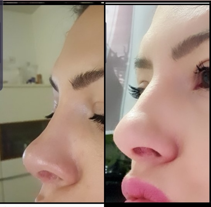 Operacija nosa