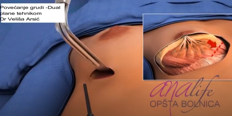 Povećanje grudi implantima - dr Arsić 