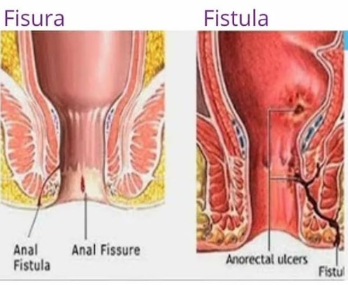 Šta je analna fistula, a šta analna fisura?