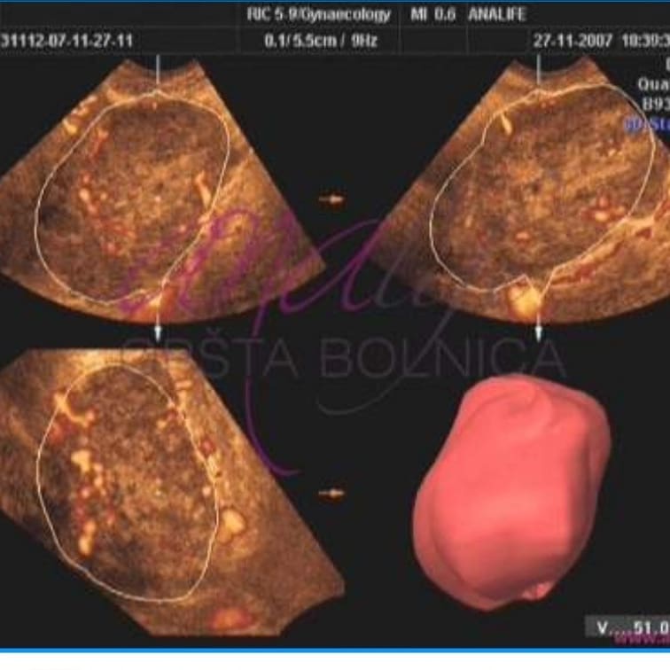 Kako se najbolje dijagnostikuju anomalije materice - 3D/2D ultrazvuk male karlice koji radi dr Živanić