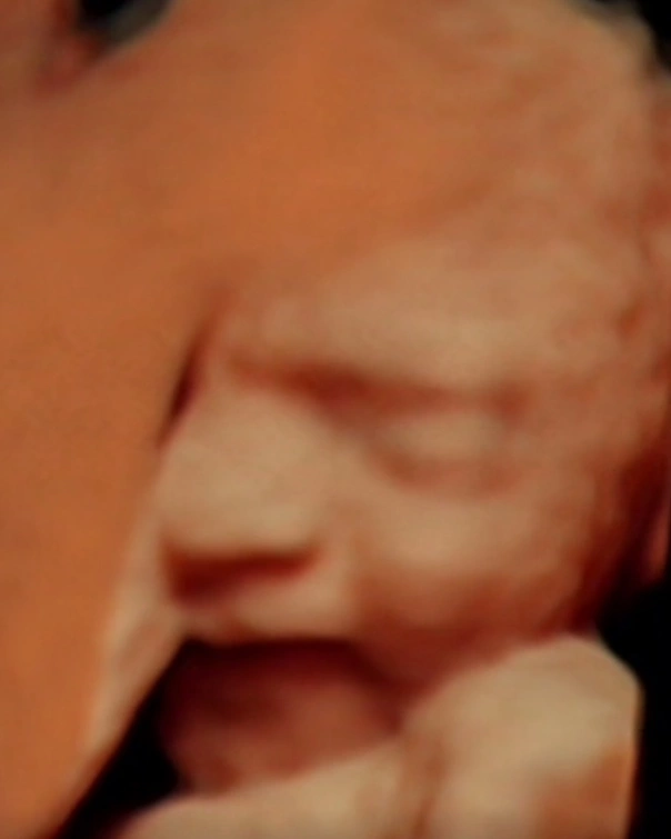 Šta je Ekspertski 4D ultrazvuk plus fetalna ehokardiografijom (FES?)