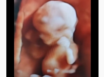 Razlika izmedju ultrazvučnog pregleda u trudnoći na 2D aparatu i 3D/4D aparatu.