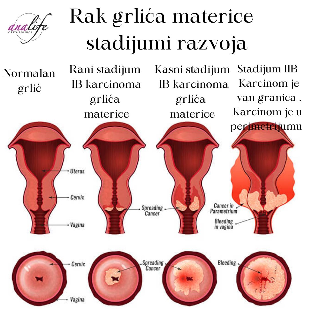 Da li ste znali da u Srbiji svakoga dana najmanje jedna žena umre a četiri žene obole od raka grlića materice!