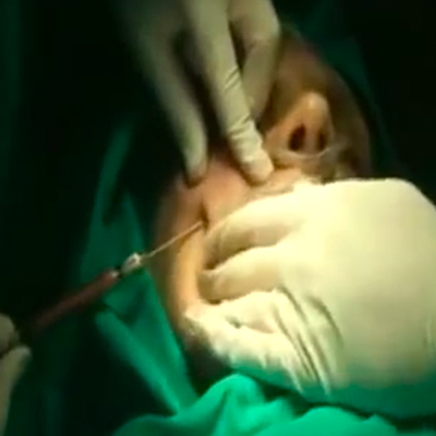 Plasticna hirurgija Laserska liposukcija_podvaljka obraza masti 