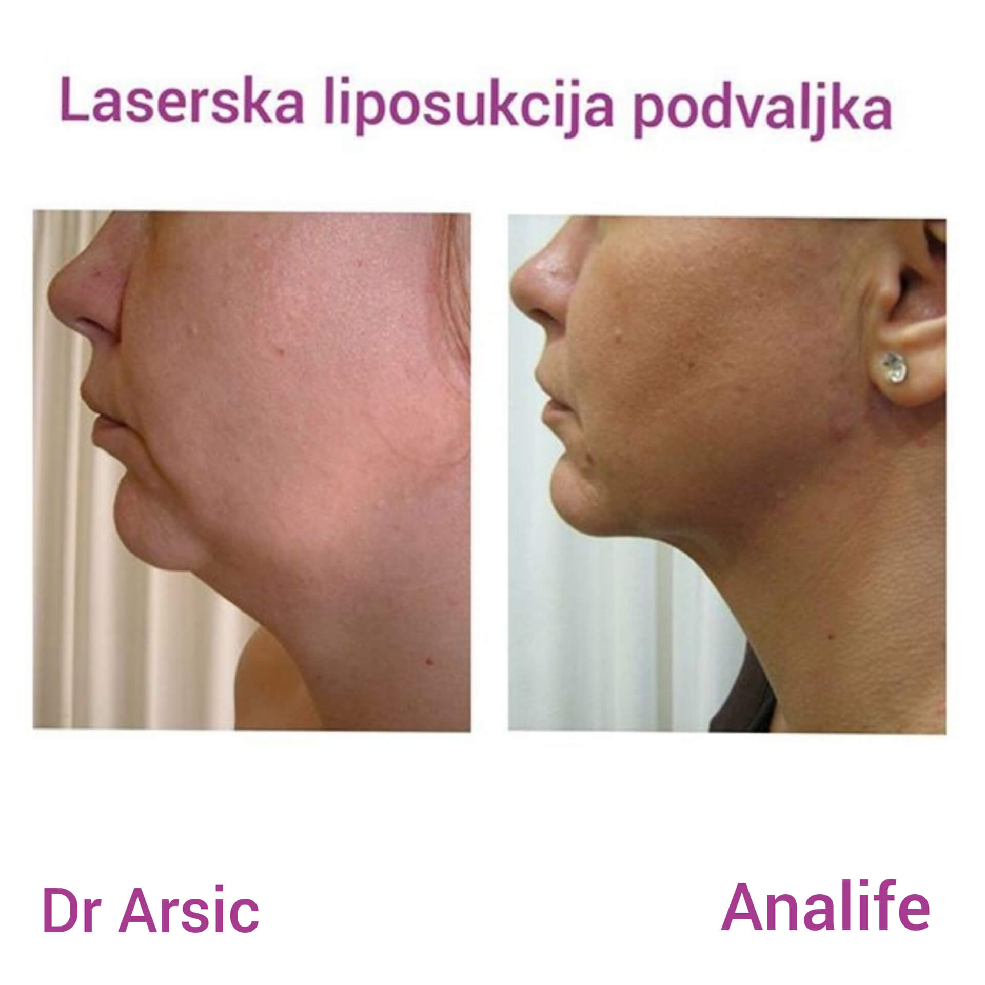 Laser jowl and cheeks liposuction Opšta Bolnica Analife