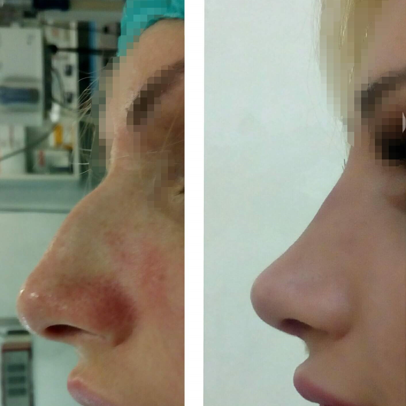 Plastična hirurgija operacija nosa 1