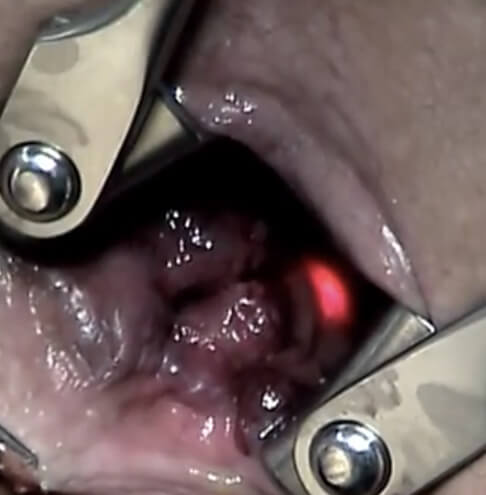 Sepetkovski hemoroidi laserksa operacija1