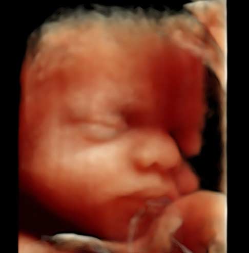 Trudnoća ekspertski 4D ultrazvuk od 20 24 nedelje trudnoće 