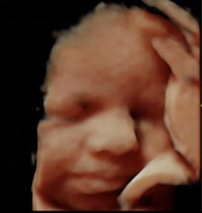 Ultrazvuk beba 