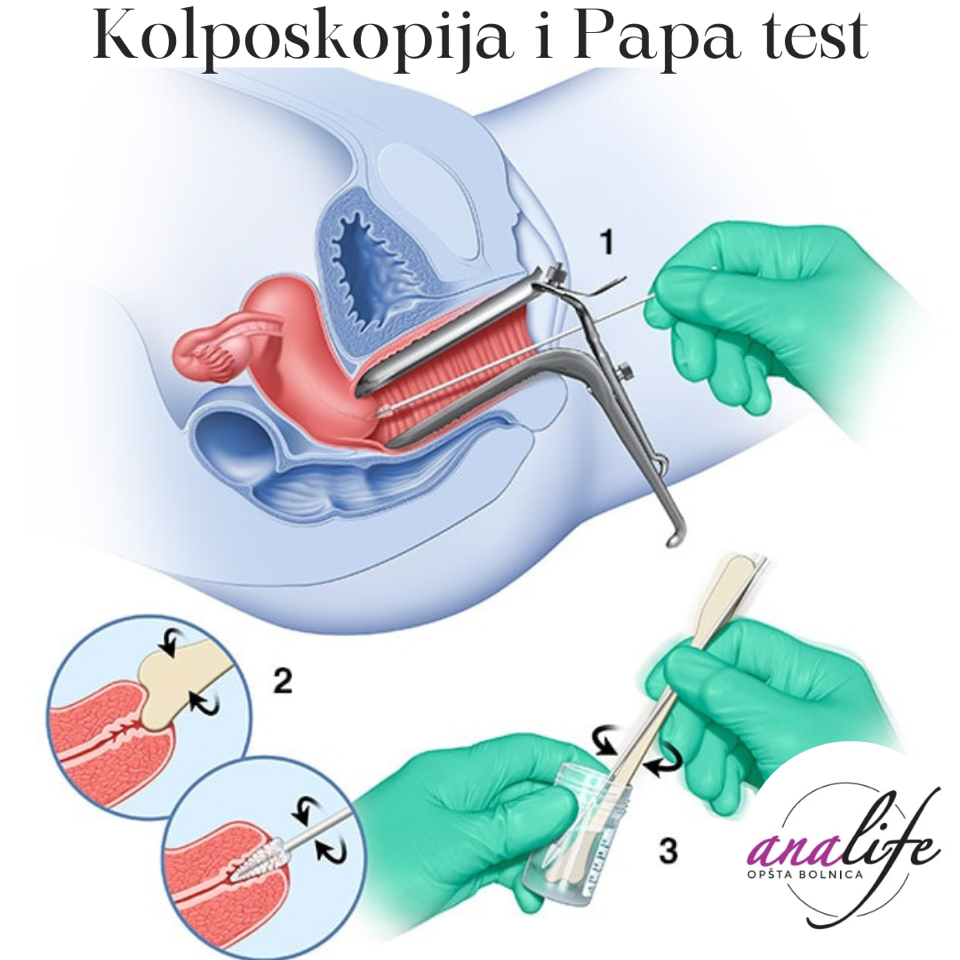 Papa test i kolposkopija – kako izgleda pregled i šta znači nalaz - slika 7