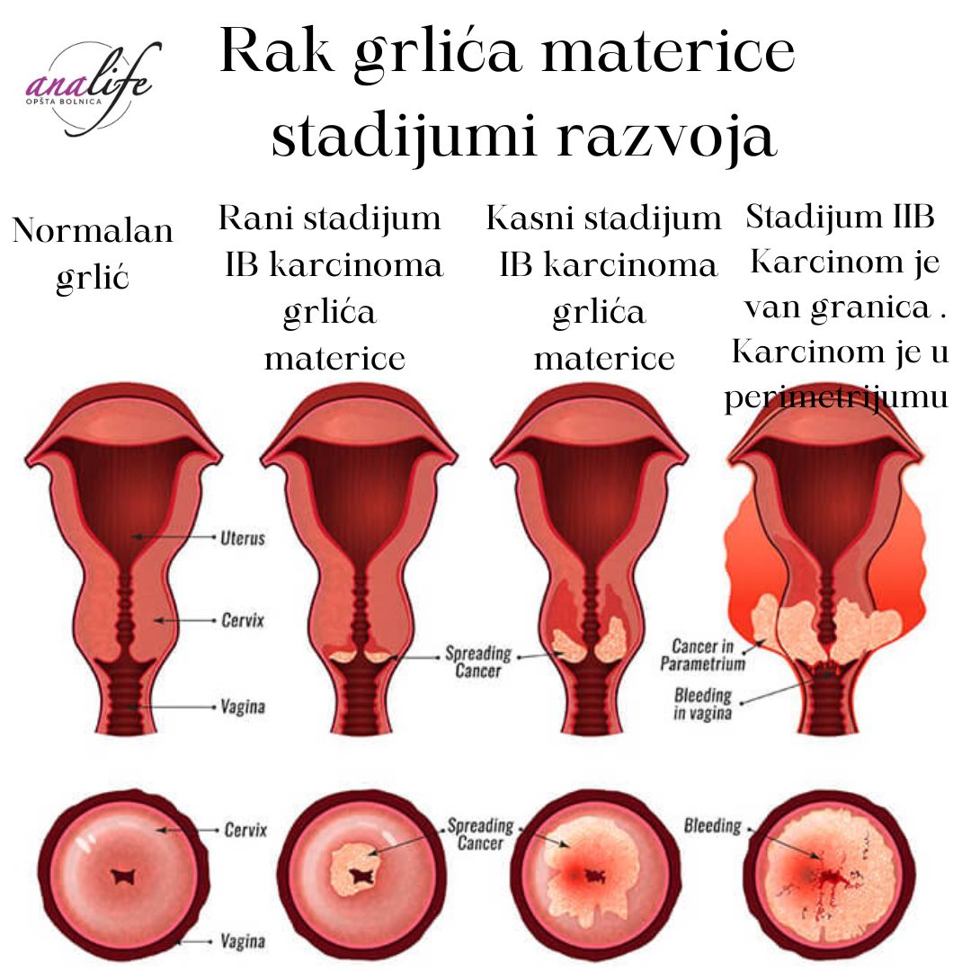 Papa test i kolposkopija – kako izgleda pregled i šta znači nalaz - slika 8