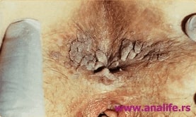 HPV tipizacija – testiranje na humani papiloma virus i procena rizika - slika 1