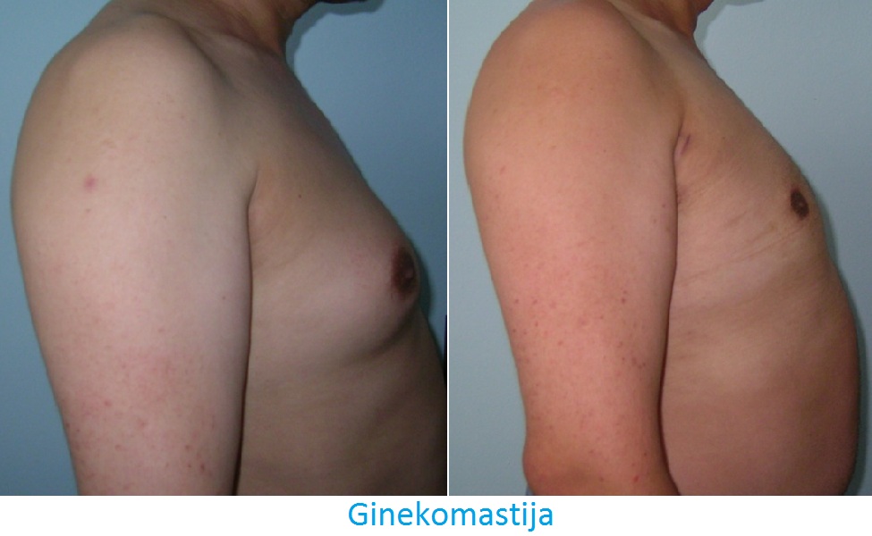 Ginekomastija – uklanjanje uvećanih muških grudi i definisan grudni koš - slika 1