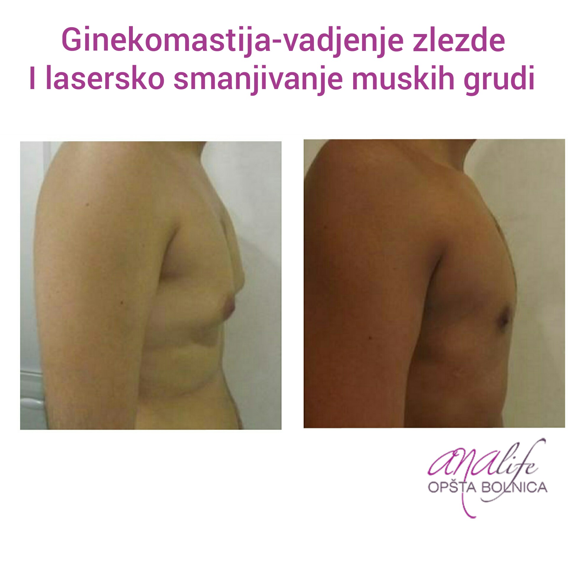 Ginekomastija – uklanjanje uvećanih muških grudi i definisan grudni koš - slika 9