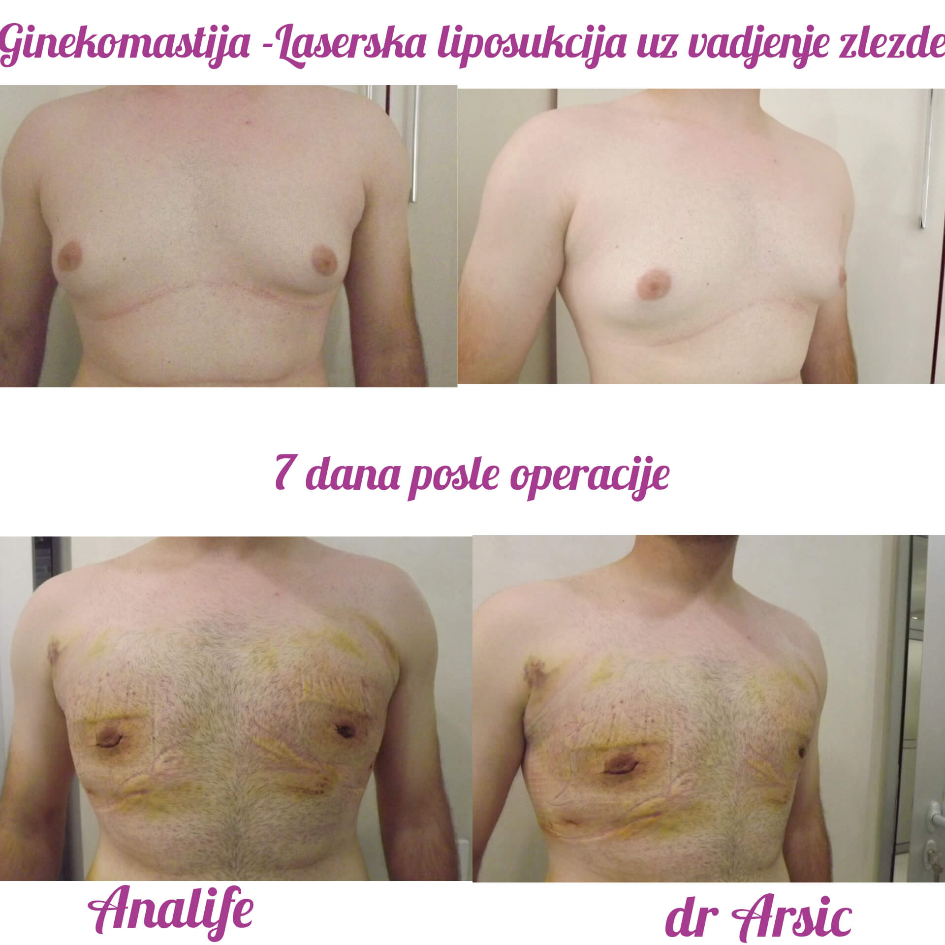 Ginekomastija – uklanjanje uvećanih muških grudi i definisan grudni koš - slika 10