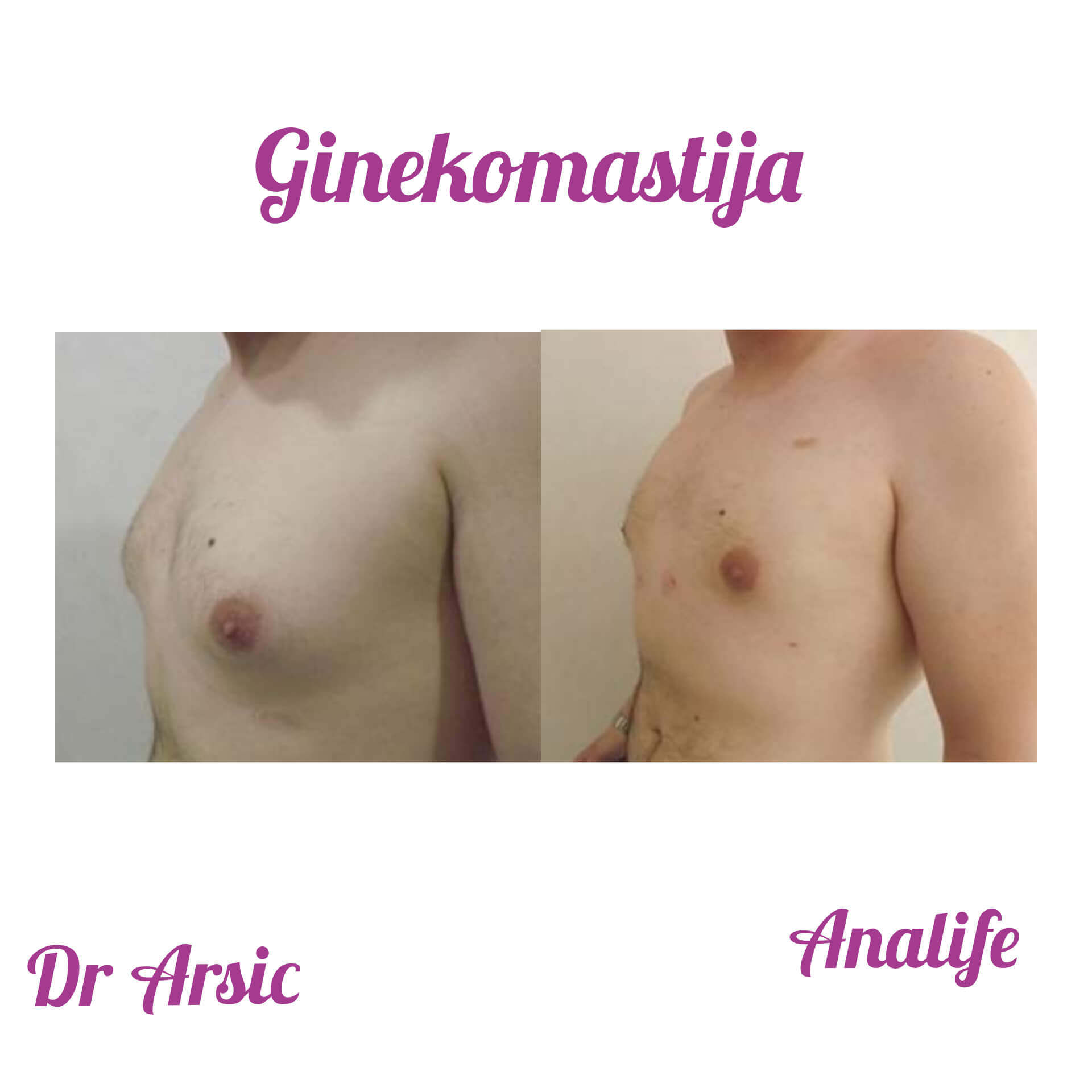 Ginekomastija – uklanjanje uvećanih muških grudi i definisan grudni koš - slika 13