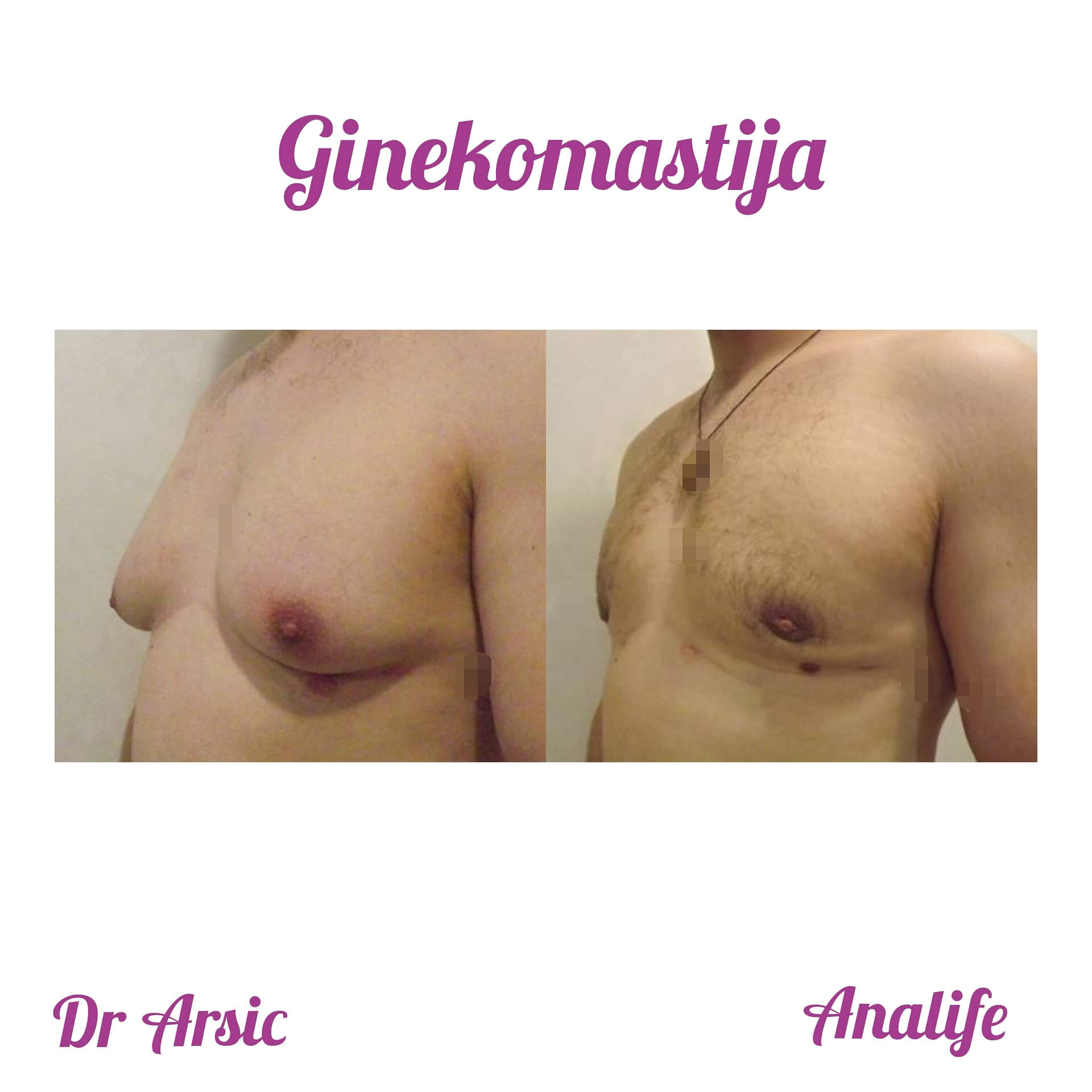 Ginekomastija – uklanjanje uvećanih muških grudi i definisan grudni koš - slika 14