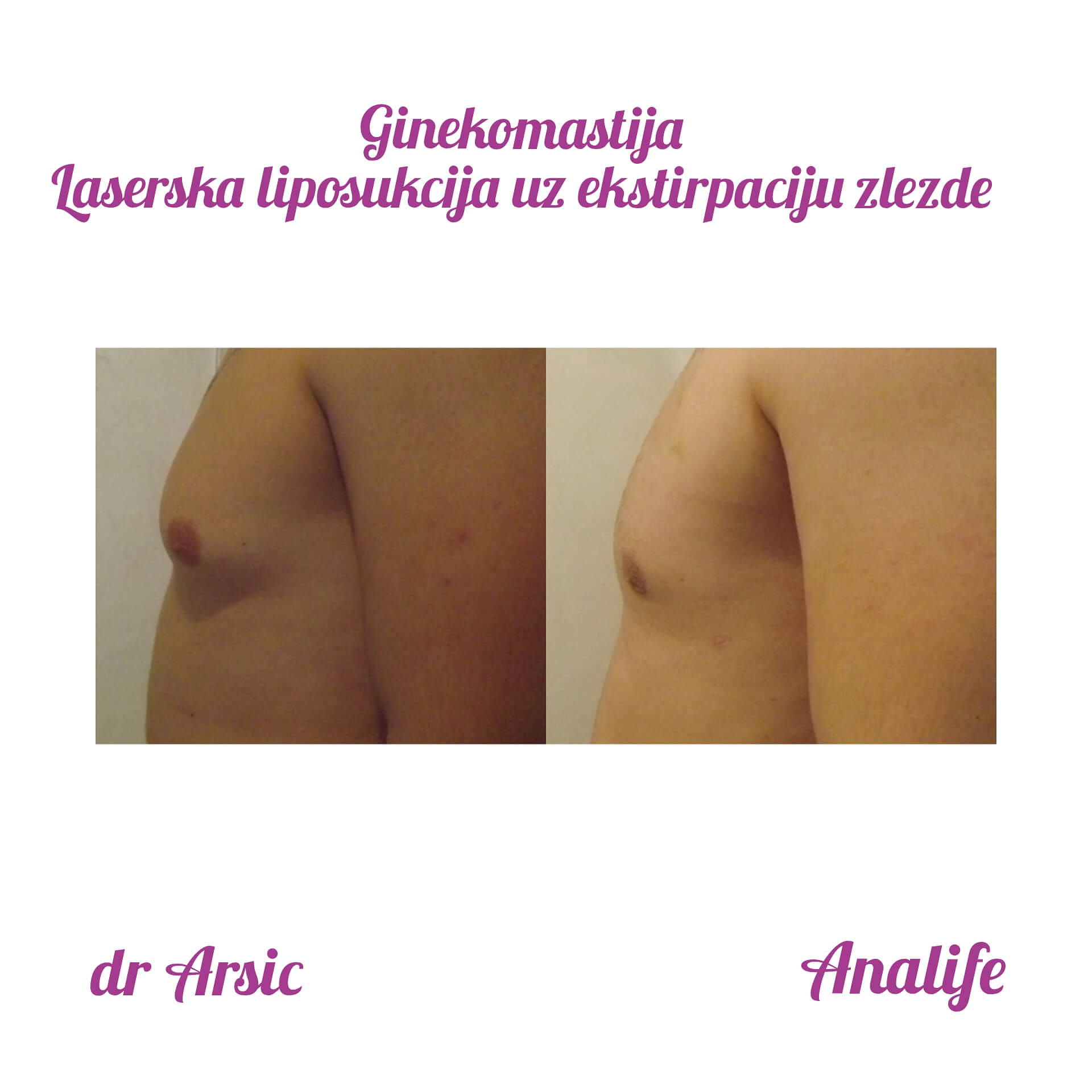 Ginekomastija – uklanjanje uvećanih muških grudi i definisan grudni koš - slika 15