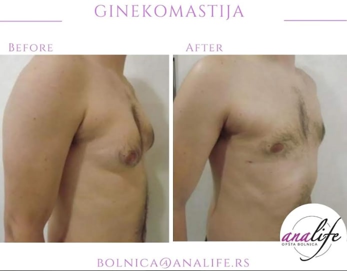 Ginekomastija – uklanjanje uvećanih muških grudi i definisan grudni koš - slika 17
