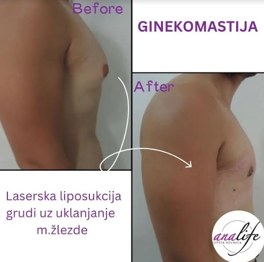 Ginekomastija – uklanjanje uvećanih muških grudi i definisan grudni koš - slika 18