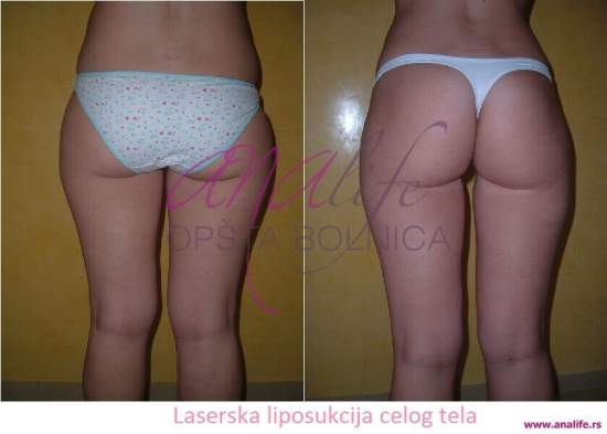 Laserska liposukcija – uklanjanje masnih naslaga i oblikovanje tela - slika 1