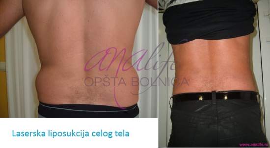 Laserska liposukcija – uklanjanje masnih naslaga i oblikovanje tela - slika 3
