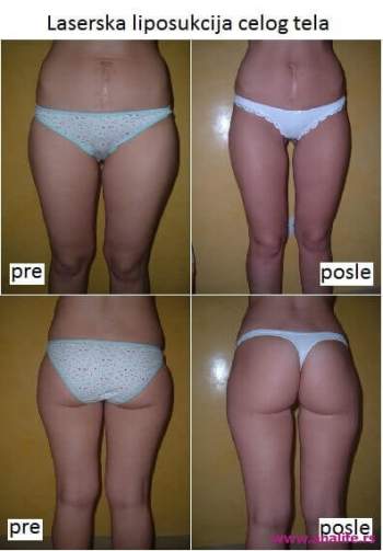 Laserska liposukcija – uklanjanje masnih naslaga i oblikovanje tela - slika 4