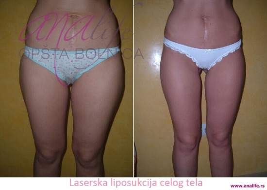 Laserska liposukcija – uklanjanje masnih naslaga i oblikovanje tela - slika 5