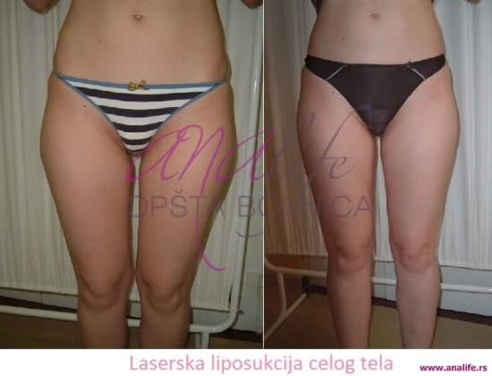 Laserska liposukcija – uklanjanje masnih naslaga i oblikovanje tela - slika 7