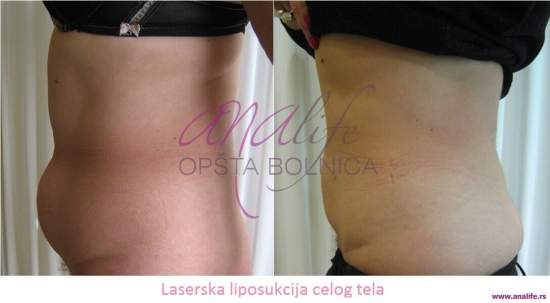 Laserska liposukcija – uklanjanje masnih naslaga i oblikovanje tela - slika 8