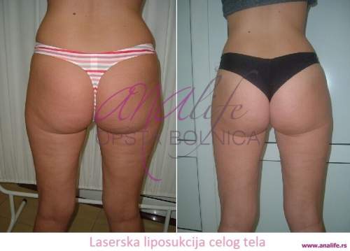 Laserska liposukcija – uklanjanje masnih naslaga i oblikovanje tela - slika 11