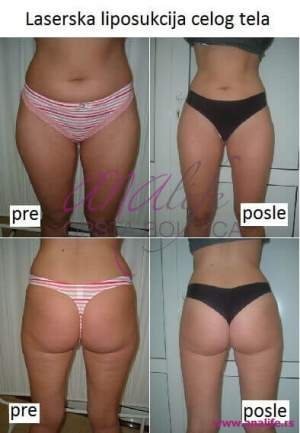 Laserska liposukcija – uklanjanje masnih naslaga i oblikovanje tela - slika 12