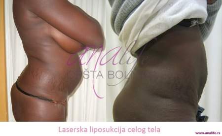 Laserska liposukcija – uklanjanje masnih naslaga i oblikovanje tela - slika 13