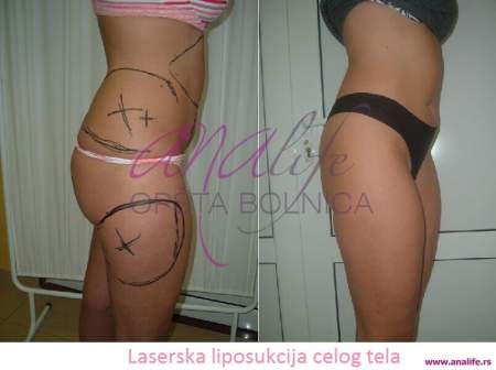 Laserska liposukcija – uklanjanje masnih naslaga i oblikovanje tela - slika 14