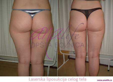 Laserska liposukcija – uklanjanje masnih naslaga i oblikovanje tela - slika 15