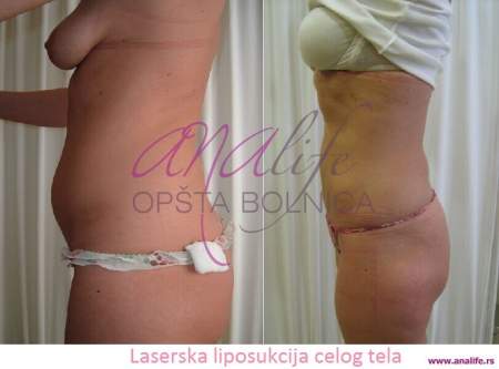 Laserska liposukcija – uklanjanje masnih naslaga i oblikovanje tela - slika 16