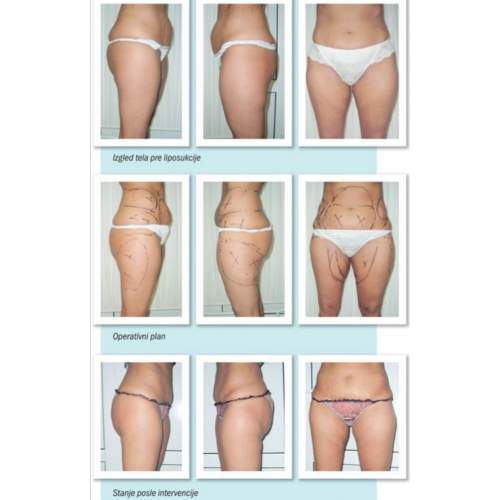 Laserska liposukcija – uklanjanje masnih naslaga i oblikovanje tela - slika 17
