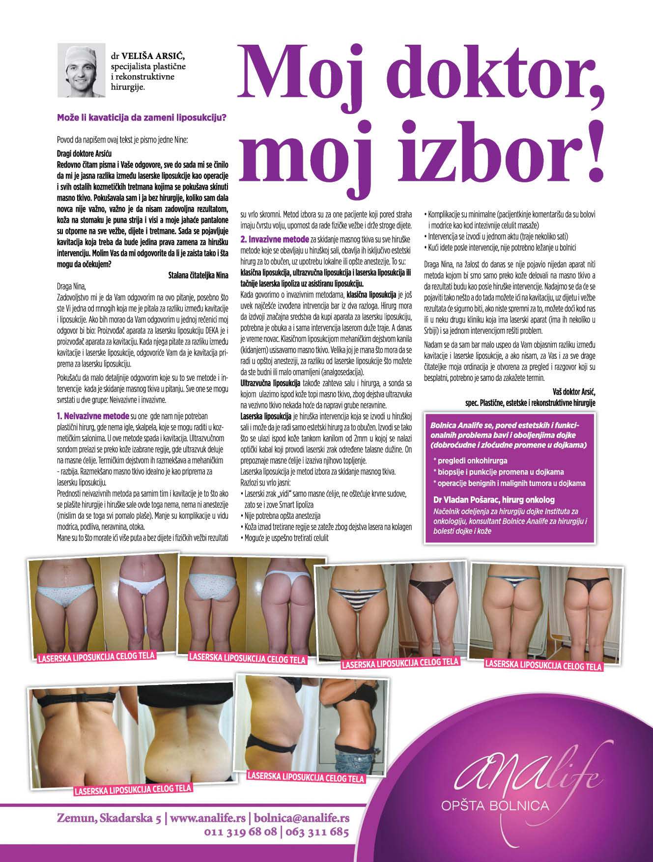 Laserska liposukcija – uklanjanje masnih naslaga i oblikovanje tela - slika 18