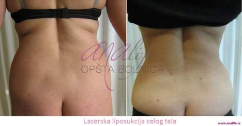 Laserska liposukcija stomaka, struka i leđa – oblikovanje linije tela - slika 3