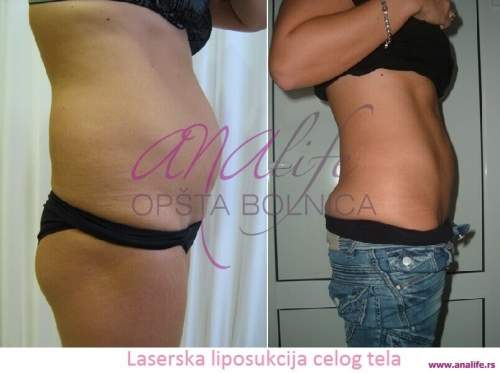 Laserska liposukcija stomaka, struka i leđa – oblikovanje linije tela - slika 4