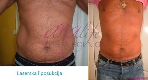 Laserska liposukcija stomaka, struka i leđa – oblikovanje linije tela - slika 5