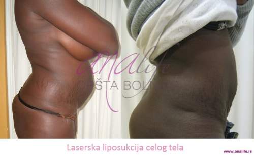 Laserska liposukcija stomaka, struka i leđa – oblikovanje linije tela - slika 6
