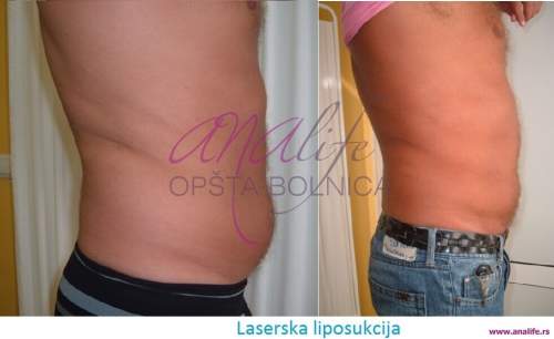 Laserska liposukcija stomaka, struka i leđa – oblikovanje linije tela - slika 7